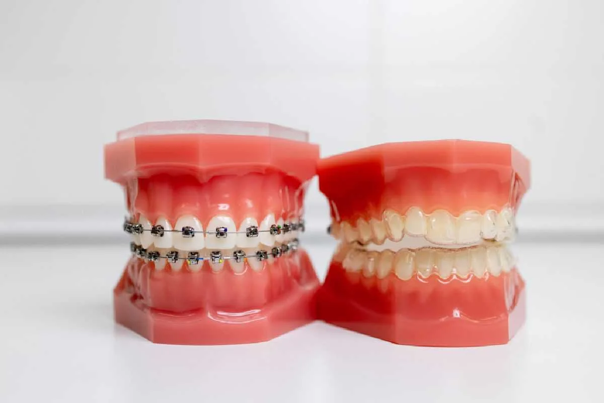 invisalign vs braces