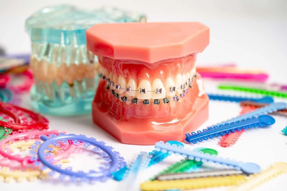 metal vs ceramic braces